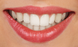 girl smiling with clear ceramic braces