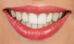 girl smiling with silver braces