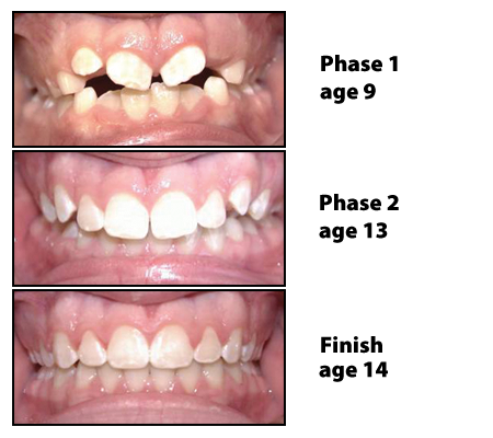 before and after photos of patient from age 9 to 14 after braces