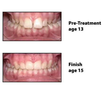 before and after photos for patient who received orthodontics
