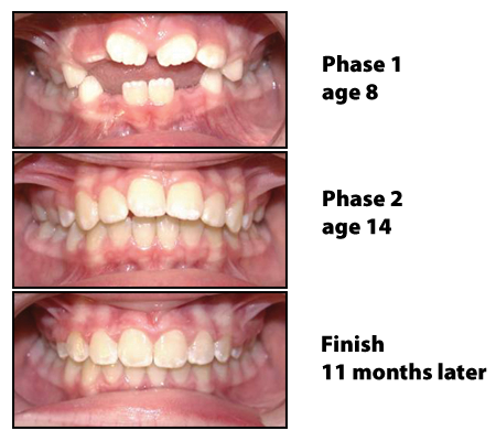 before and after photos for patient who received orthodontics